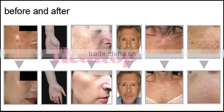 Skin laser machine dermatology professional resurfacing vagina tightening fractional laser cutting machine co2 equipment