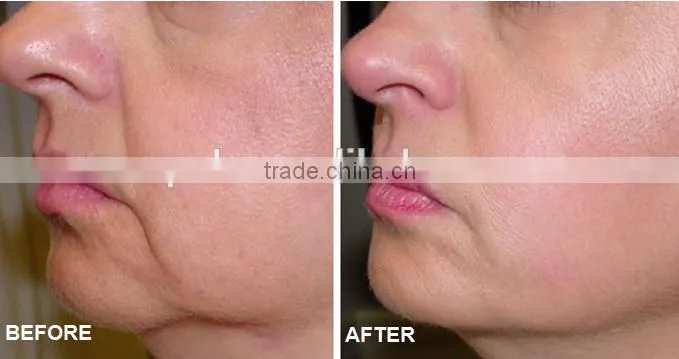 Factory supply directly Cavitation and Vacuum slimming system