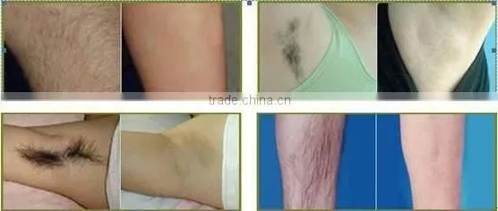 Factory offer medical equipment laser therapy for hair removal, 808nm diode laser beauty equipment