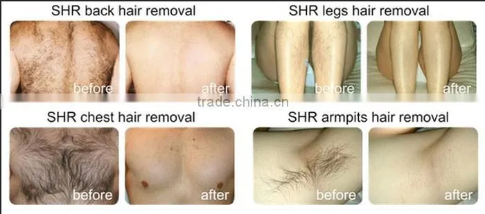 2016 Most popular beauty equipment 4in1 RF/OPT/Laser/Elight Hair Removal Machine