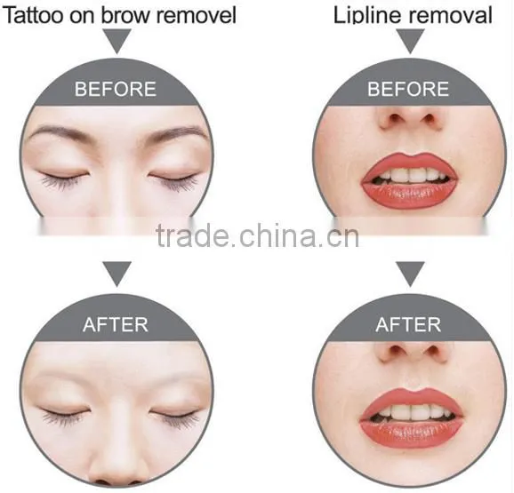 Eyebrow tattoo removal machine