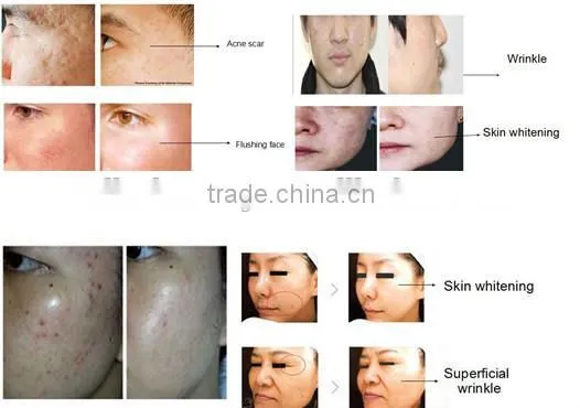 Very excellent portable wrinkle, fractional rf and micro needle machinefor clinic ,beauty spa and so on