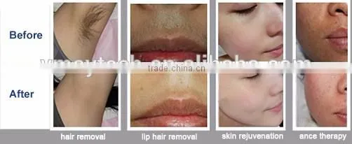 portable elight ipl hair removal equipment for sale VH609