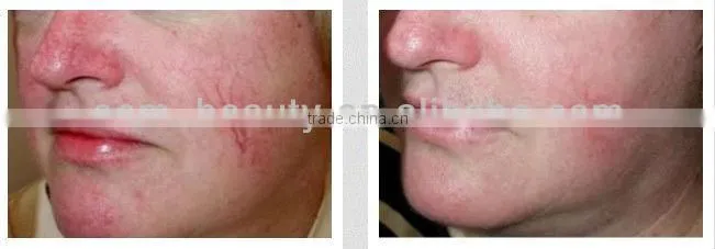 L007 derma roller 1.5 stretch marks, private dermaroller