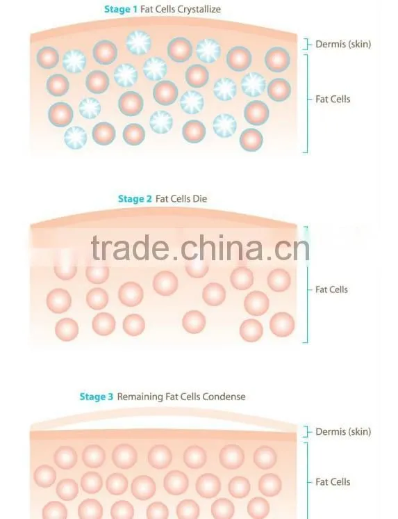 2014 bottom price 2 specialist cryolipolysis hand pieces vertical cryolipolysis cryotherapy beauty apparatus