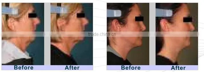 salon equipment supply F2 hifu for skin tightening