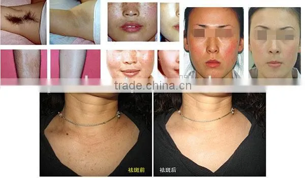 2014 Professional lumenis ipl quantum For Hair Removal(ce Iso)