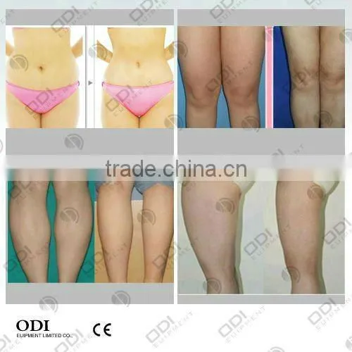 Good customers feedback weight loss machine OD-S10