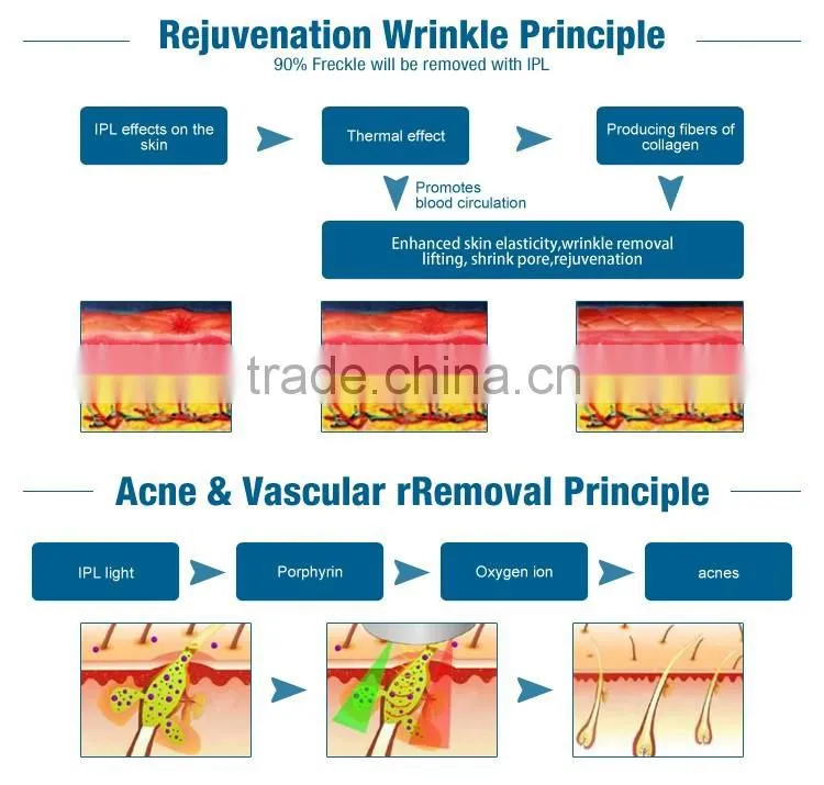 Hot sale elight shr ipl shr hair removal beauty equipment treatment for face and body