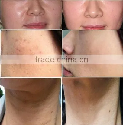 Disposable microneedling dermaroller for hair loss treatment