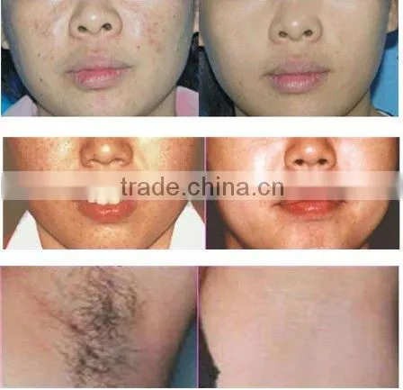 SHR and elight hair removal machine