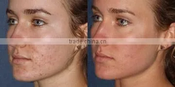 Skin Tightening fractional co2 laser equipment, Skin Rejuvenation co2 laser scar removal Acne Treatment