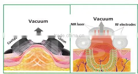 alibaba lipo massage beauty machine equipment/cavitation tripolar multipolar bipolar rf machine