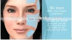 High Quality Hifu non surgical face lift Ultrasound Skin Tightening machine