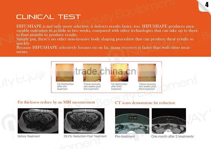 HIFUSHAPE nubway hifu for body slimming fat loss hifu equipment