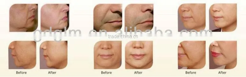 2016 F-018 Promotion Professional micro needle fractional rf system with cooling