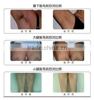 hot new product for 2015 high power laser 808nm diode laser hair removal machine