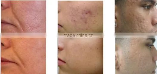 portable rf lifting treatment products bipolar RF wrinkle remover machine