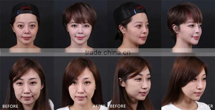 CE approval No surgery professional 3D face lift hifu u-one