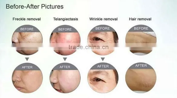 2014professional elight spare parts laser hair removal with 9 filters(CE,ISO,SGS,TUV)