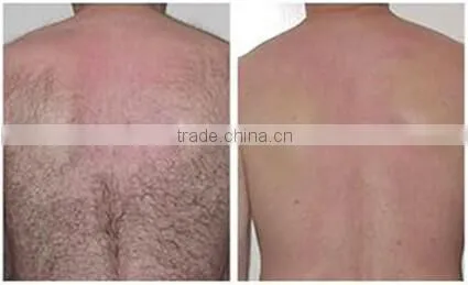 Professional portabel big spot size epilation IPL laser hair removal machine for beauty salon spa clinic
