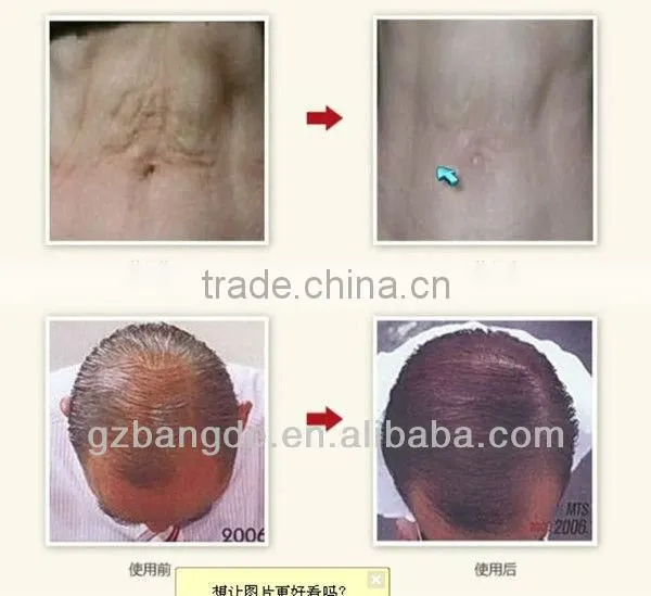 Handheld electric microneedle in derma rolling system BD-WZ001