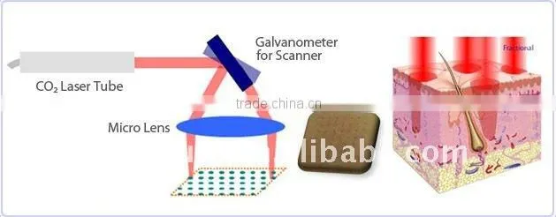 tattoo removal laser equipment