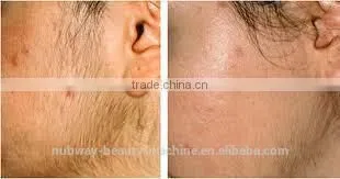 Best Quality Laser Hair Removal Machine IPL Laser Skin Rejuvenation IPL Machine Made In Germany