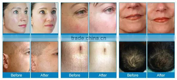 Latest micro needle 3 in 1 skin acne derma roller system