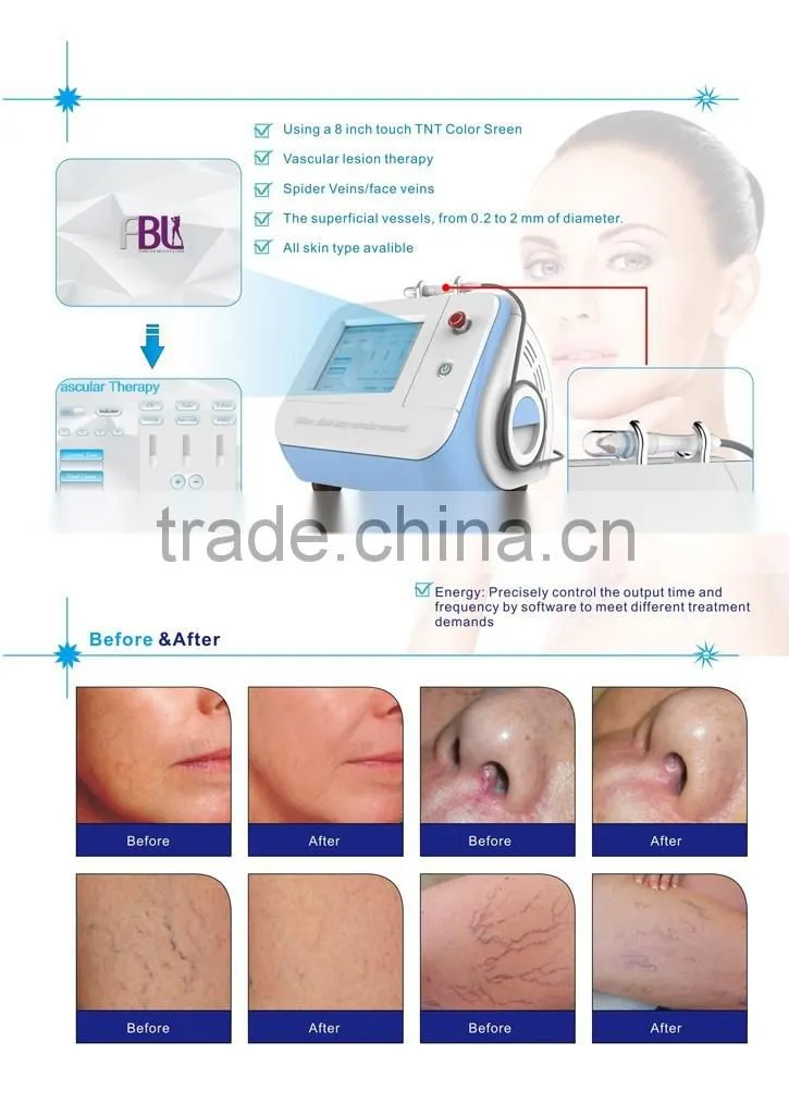 Promotion price: 980nm diode laser spider vein removal machine--RBS300