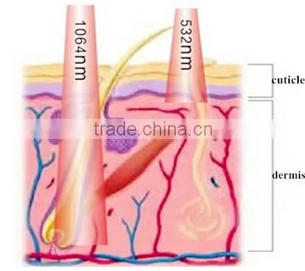 Laser Beauty Machine Q Switched nd:yag Laser Tattoo Removal machine prices