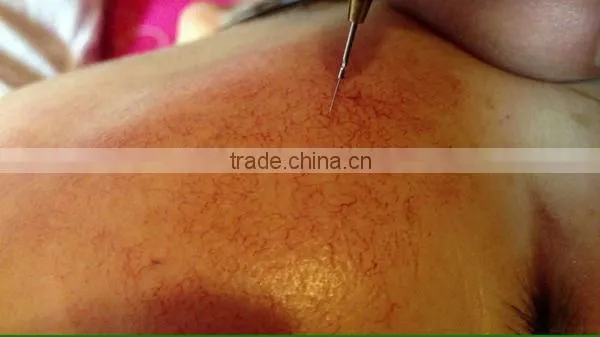 vascular removal spider veins removal