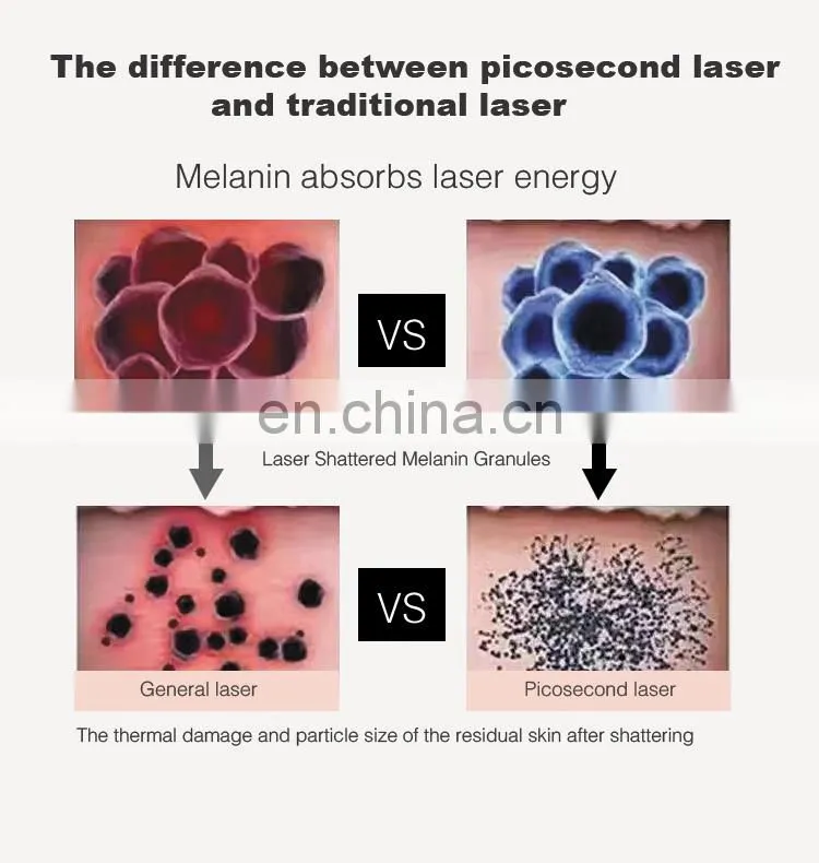 Korea Imported Nd Yag Laser Arm Pigment Tattoo Removal Picosecond Machine 755nm Pico Laser Price