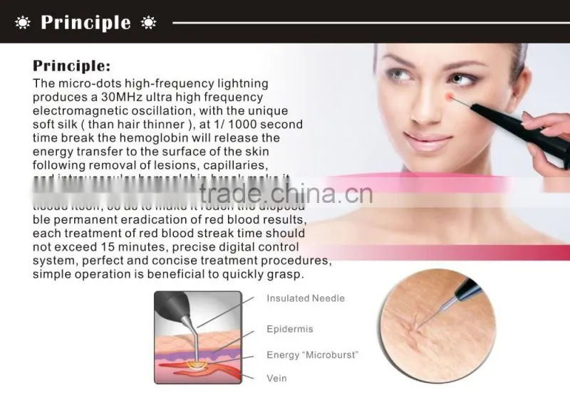 High Radio Frequency Portable Spider Vein Removal Machine