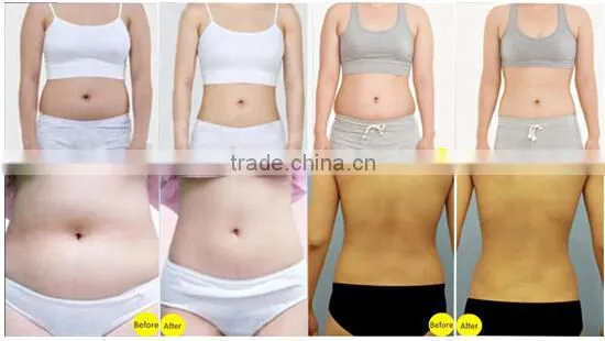 high intensity focused ultrasound weight loss slimming machine for sale