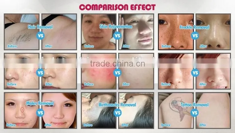 New type multifunction equipment ipl laser treatment