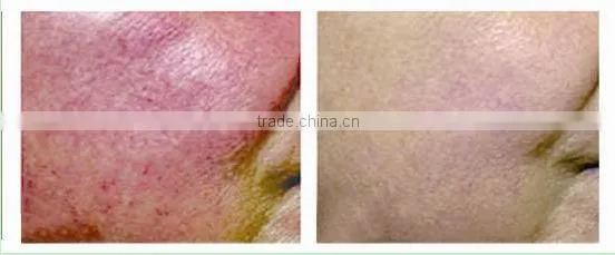 Promotion! most advanced spider vein
