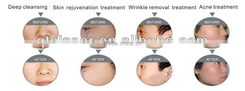 skin rejuvenation meso gun laser beauty machine meso therapy gun