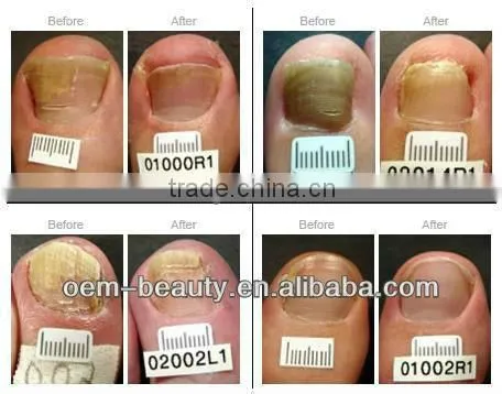 Distributors wanted Medical Q-switche laser 1064nm ND YAG home alexandrite laser hair removal machine