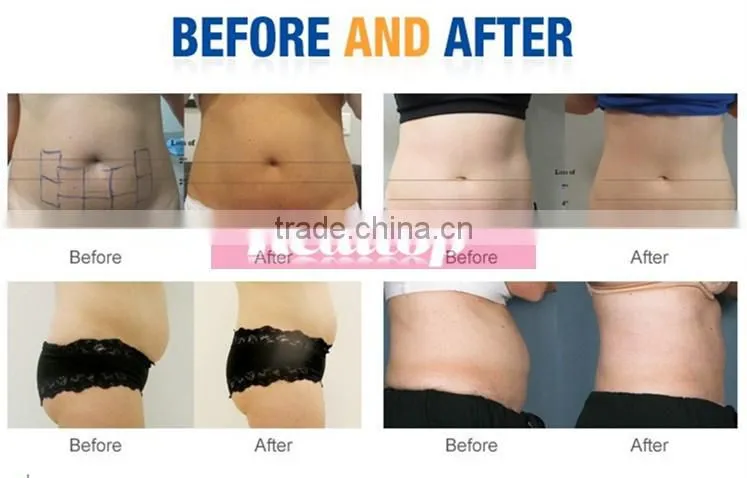 Professional ultrasounic hifu body shape machine ultrashape liposonic hifu slimming machine on sale
