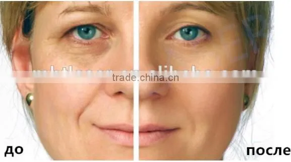 NEW! 5 cartridges 10000 shots Promotion price HIFU for face lift anti-aging wrinkle removal high intensity focused untrasound