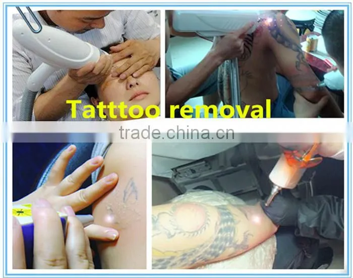 nd yag home use laser tattoo removal machine