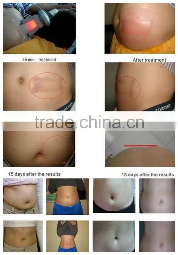 Cavitation Vacuum RF Body Slimming Tripolar Radio Frequency Skin Tighten Machine