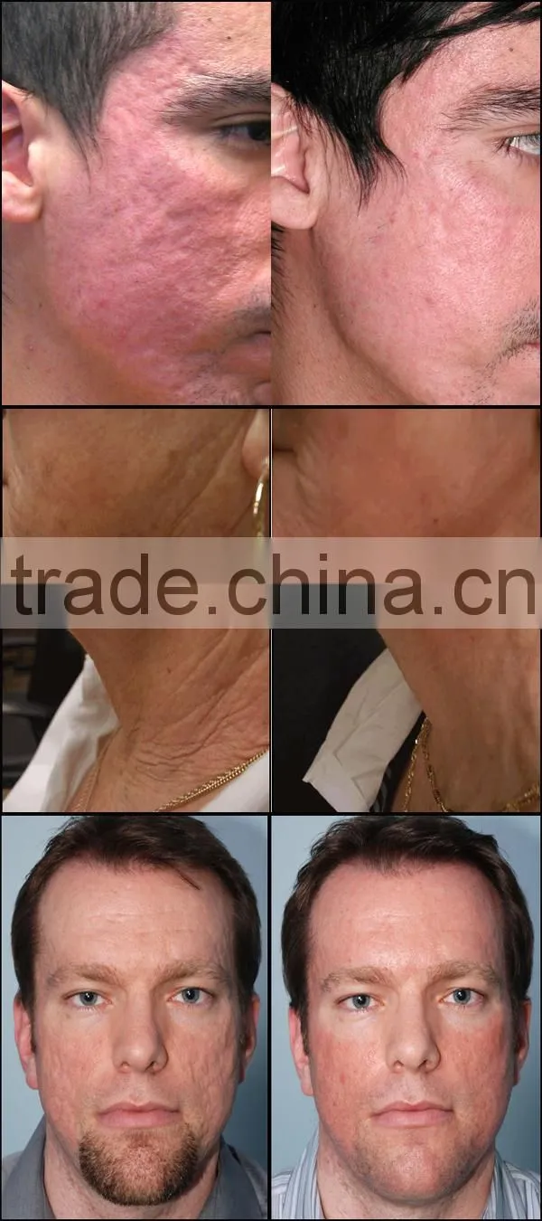 Manufacturer supply 2Mhz 50w portable wrinkle removal fractional rf machine