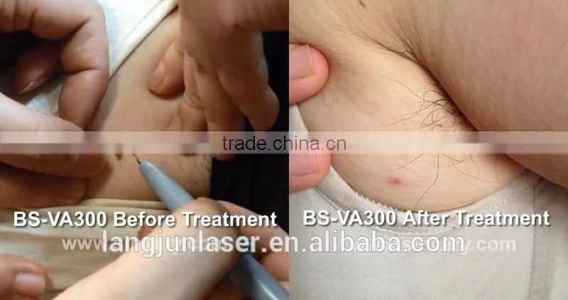 Spider Vein Removal/Vascular Removal