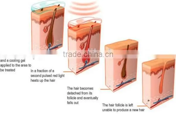 Apolomed Supper price home use ipl laser permanent hair removal machine for facial care