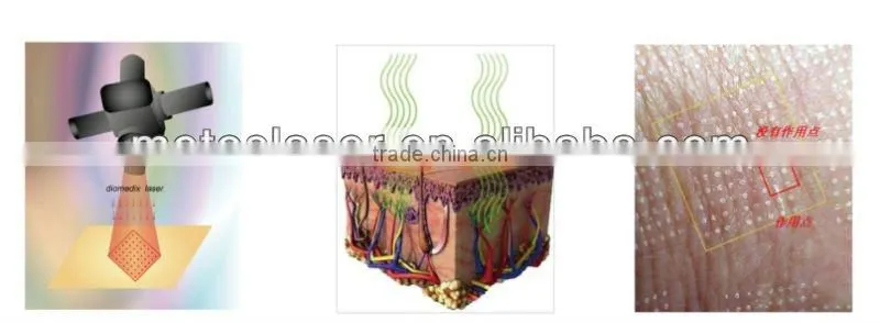 RF Excited Fractional CO2 Laser/ CO2 fractional laser
