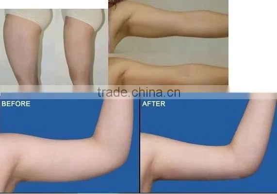2011 portable ultrasonic liposuction RF slimming equipment