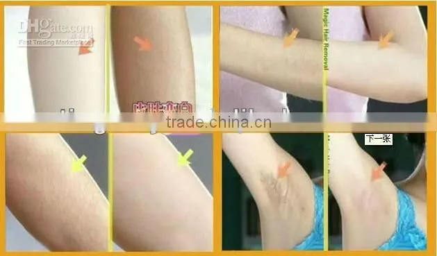 Portable Hair Remover Laser System