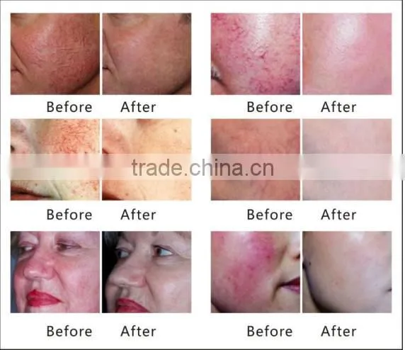 Spider Vein Removal machine Beauty Salon / Clinic/ Spa use Machine